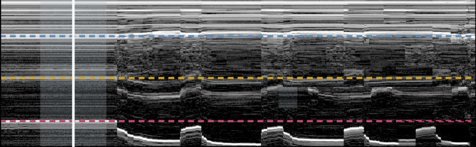 Thirty seconds of M-mode through the quadriceps: skin and fat at the top, then rectus femoris, vastus intermedius and the femur echo, which steps deeper during each of four stimulation windows.